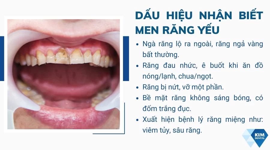 Dấu hiệu nhận biết men răng yếu